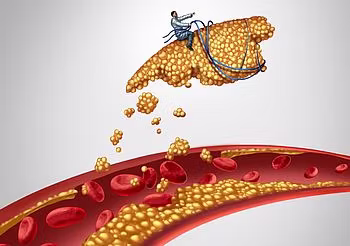 blaszka miażdżycowa oderwana od naczynia krwionośnego