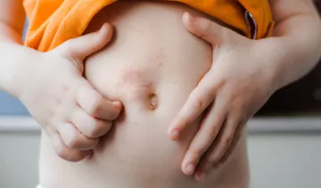 Świerzb - objawy i przyczyny. Jak wygląda świerzb i jak długo się go leczy?