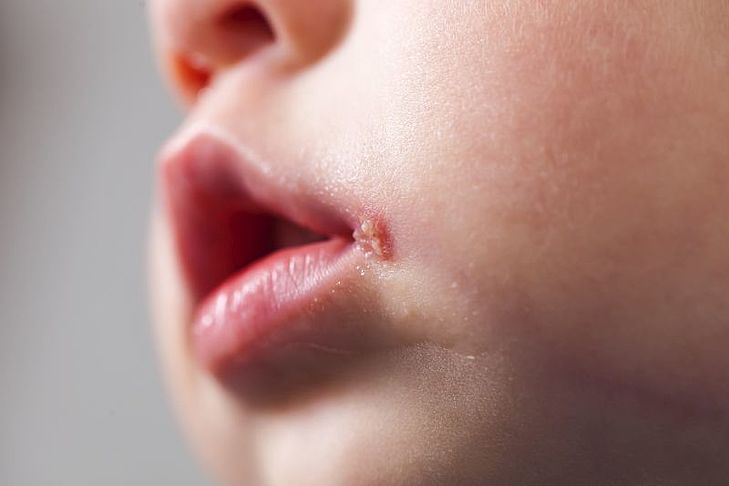 Nieswoiste zapalenie jelit (IBD) – objawy, przyczyny, leczenie i dieta