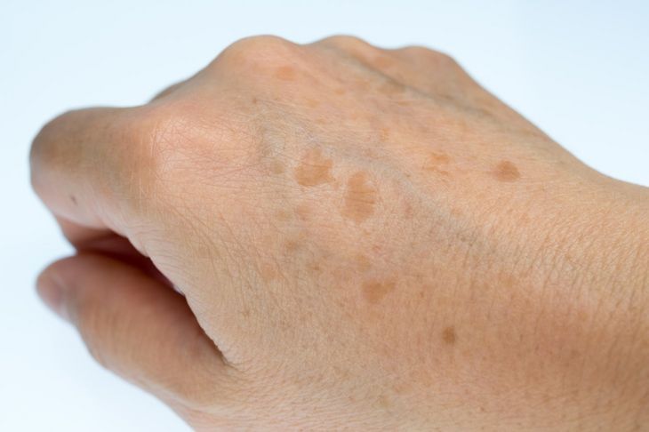 Plamy wątrobowe, inaczej plamy pigmentacyjne albo plamy starcze, pojawiają się głównie w miejscach wystawionych na działanie słońca — na zewnętrznej stronie dłoni, na twarzy, dekolcie i ramionach. Fot. Adobe Stock.