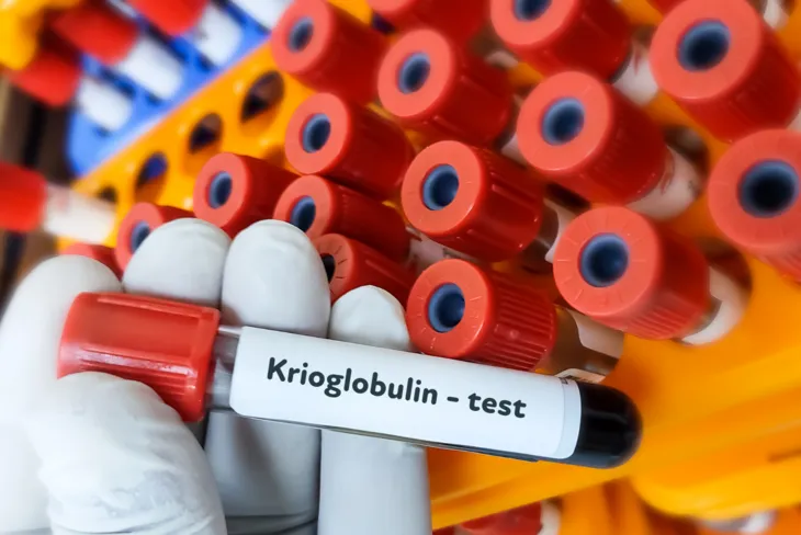 Krioglobuliny to nieprawidłowe przeciwciała wytrącające się z krwi na skutek znacznego obniżenia temperatury. /Fot. Canva