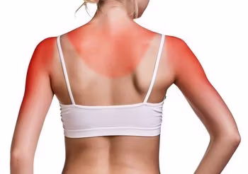 kobieta z bradzo opalonymi ramionami