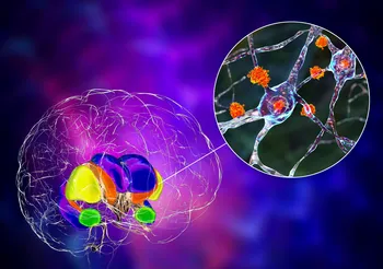 Choroba Huntingtona wynika ze zmian w budowie białka, tzw. huntingtyny. Zbiera się ona w komórkach nerwowych mózgu i je uszkadza, przez co stan chorego się pogarsza.