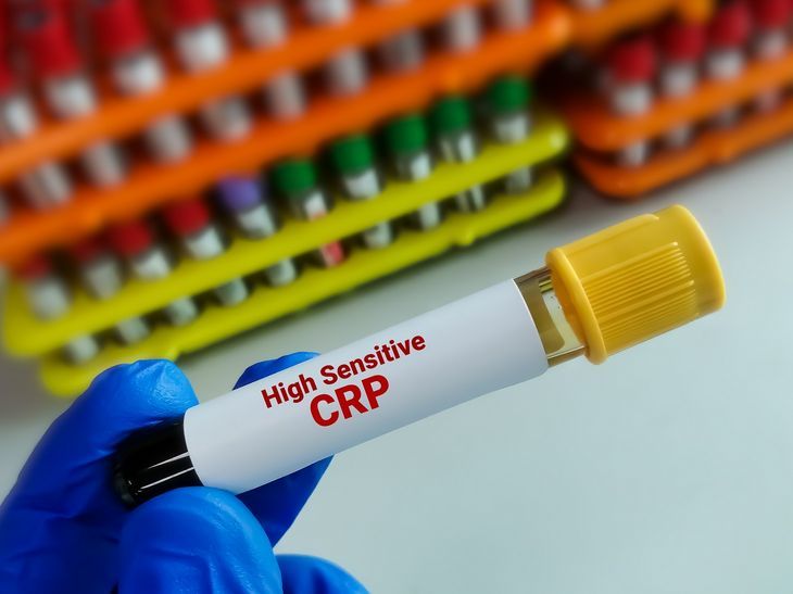 Badanie biała C-reaktywnego jest jedną z częstszych metod laboratoryjnych, stosowanych w diagnozowaniu nowotworów / Fot. Adobe Stock