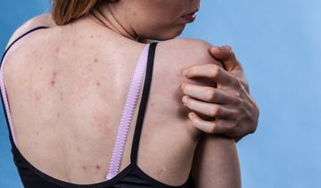 Trądzik na plecach − blizny i przebarwienia. Jak się ich pozbyć?