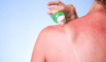 Co stosować na oparzenia słoneczne? Preparaty i domowe sposoby na oparzenia