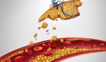Cholesterol – dobry i zły (HDL i LDL). Normy cholesterolu, jak obniżyć jego poziom?