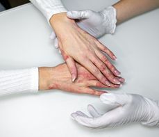 Alergia kontaktowa – objawy na twarzy, na dłoniach, leczenie