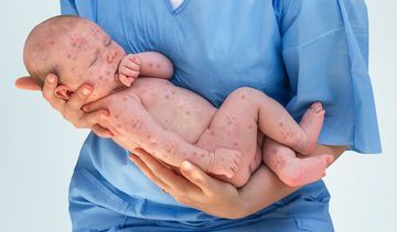 Jakie są objawy odry i jak się przed nią chronić?