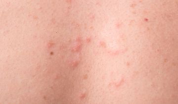 Trądzik grzybiczy – jak wygląda? Czy na trądzik grzybiczy stosuje się maść?