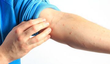 Odczulanie przy atopowym zapaleniu skóry