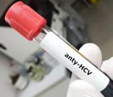 Anty-HCV — na czym polega badanie i kiedy je wykonać? Przygotowanie, normy i interpretacja