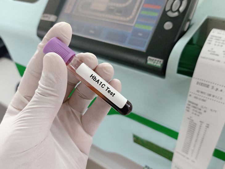 Hemoglobina glikowana (HbA1C) powstaje na skutek glikacji globiny, czyli połączenia glukozy z hemoglobiną. /Fot. Adobe Stock