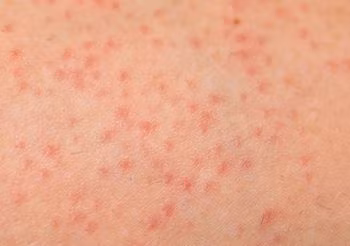 Zapalenie mieszków włosowych ma najczęściej podłoże bakteryjne, dlatego leczenie domowymi sposobami nie jest skuteczne. Lekarz przepisuje zwykle maści z antybiotykiem. Fot. Adobe Stock.