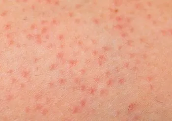 Zapalenie mieszków włosowych ma najczęściej podłoże bakteryjne, dlatego leczenie domowymi sposobami nie jest skuteczne. Lekarz przepisuje zwykle maści z antybiotykiem. Fot. Adobe Stock.