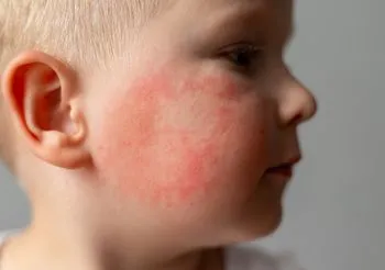 Rumień zakaźny objawia się jasnoczerwoną rozlaną wysypką na policzkach, niekiedy na całym ciele. Co ciekawe, rumień nie obejmuje nosa ani brody.