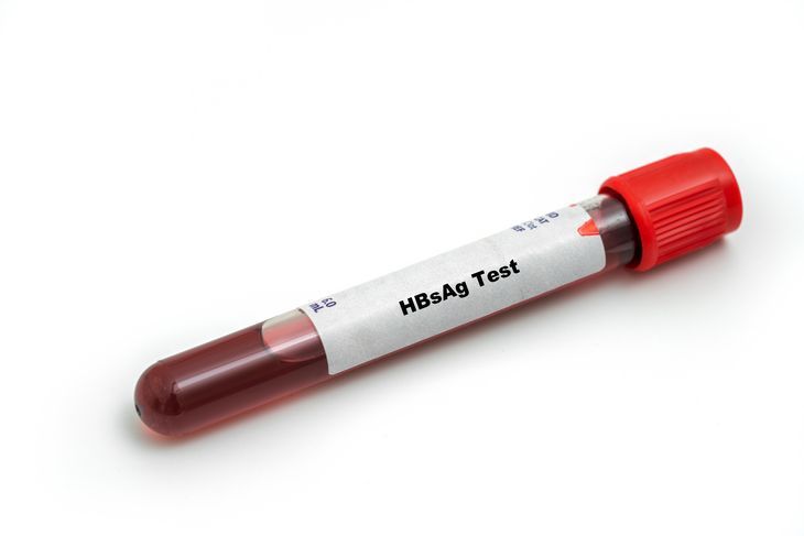 Antygen HbsAg, a ściślej mówiąc, jego oznaczenie we krwi, pozwala na zdiagnozowanie wirusowego zapalenia wątroby typu B. /Fot. Adobe Stock