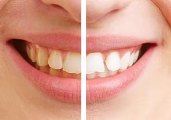 wybielanie zębów - działanie past wybielających 