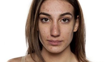 Jak pozbyć się trądziku młodzieńczego?