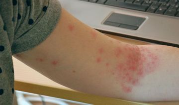 Atopowe zapalenie skóry – trudności diagnostyczne