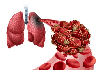 Zatorowość płucna to zwężenie lub zamknięcie światła tętnicy płucnej przez skrzepliny. Jest bardzo niebezpieczna, ponieważ może przebiegać bezobjawowo. Fot. Adobe Stock.