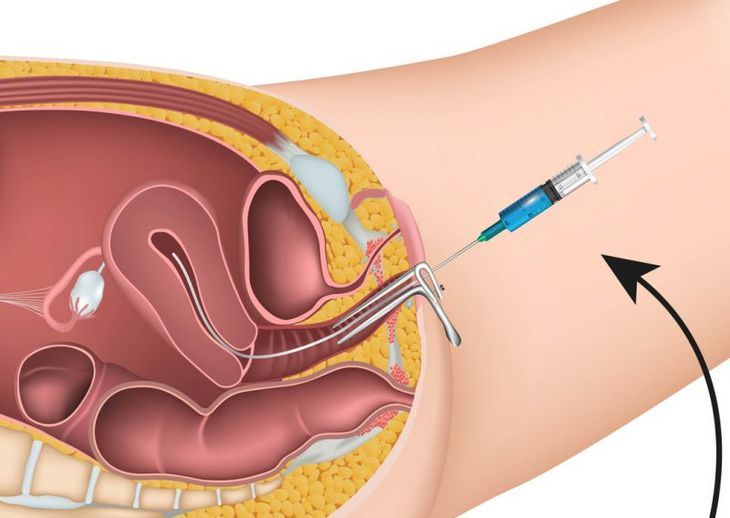 jak wygląda zabieg inseminacji domacicznej sztuczne zapłodnienie