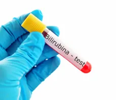 Bilirubina – normy, wskazania, przygotowanie. Jak obniżyć?