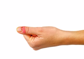 Zastrzał okołopaznokciowy to bolesna zmiana ze zbierającą się ropą. Zaniedbany stan zapalny może ze skóry rozlać się na tkankę podskórną, ścięgno, kość lub przekształcić się w ropowicę. Fot. Adobe Stock.