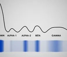 Elektroforeza białek surowicy krwi (proteinogram) – na czym polega badanie? Normy, wskazania, przygotowanie