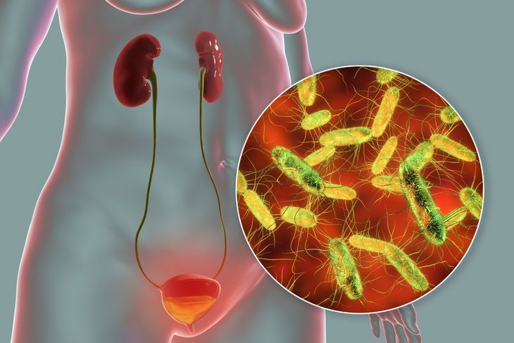 Prawie 90 proc. zakażeń pęcherza powoduje bakteria Escherichia coli, która dostaje się do dróg moczowych. Na wnikanie bakterii tą drogą bardziej narażone są kobiety.