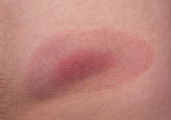 Rumień po kleszczu przybiera postać rozległego (powyżej 5 cm średnicy) zaczerwienienia wokół miejsca wkłucia kleszcza, widać na nim wysypkę.