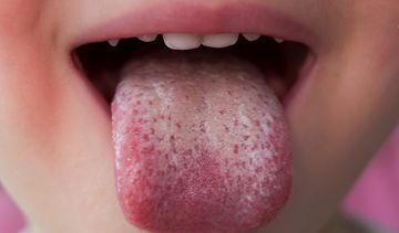 Grzybica jamy ustnej – objawy, leczenie. Czy leki bez recepty pomogą?