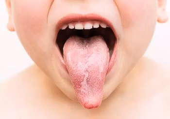 Czerwone plamy na języku u dziecka przypominające kształtem mapę to objaw choroby zwanej język geograficzny. 