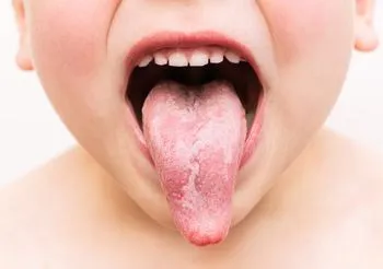 Czerwone plamy na języku u dziecka przypominające kształtem mapę to objaw choroby zwanej język geograficzny. 