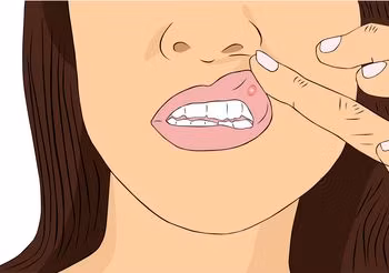 Grafika przedstawia problem aft w jamie ustnej.