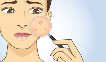 Maść ichtiolowa – skład, działanie, na co pomaga