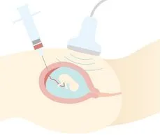 Biopsja kosmówki – co to za badanie? Normy, wskazania, przygotowanie