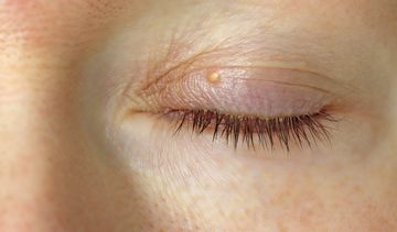 Kaszak – czy jest groźny? Rozpoznanie, leczenie kaszaka