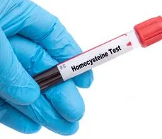 Oznaczenie poziomu homocysteiny – na czym polega badanie? Normy, wskazania, przygotowanie