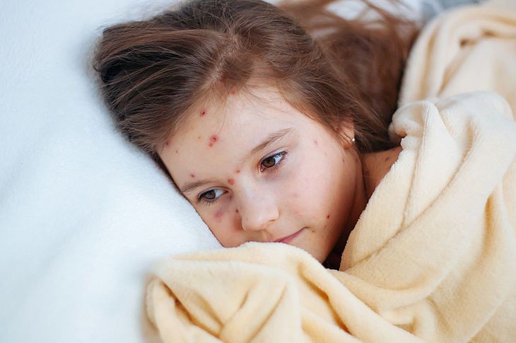 Kilkuletnia dziewczynka z objawami ospy na buzi leży pod kocem
