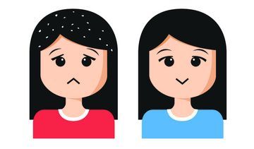 Łupież suchy, tłusty, pstry – przyczyny, objawy, leczenie