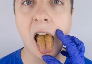 Żółty język bywa skutkiem nieprawidłowej higieny jamy ustnej, palenia papierosów lub nadmiernego picia kawy.