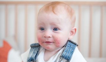 Atopowe zapalenie skóry u dzieci – objawy i leczenie