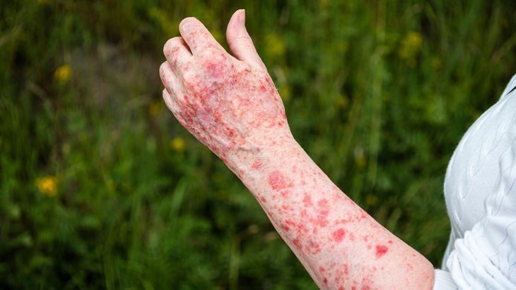 W przypadku fotodermatozy nawet po niewielkiej dawce słońca na skórze pojawiają się liczne zmiany, jak się rumień, wysypka, wyprysk.