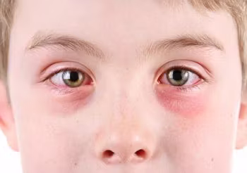 Bakteryjne zapalenie spojówek zazwyczaj występuje w obydwu oczach i najczęściej dotyczy dzieci. Objawy to wydzielina ropna, przekrwienie i obrzęk powiek. Fot. Adobe Stock.