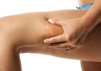 Rodzje cellulitu, sposoby na pozbycie się cellulitu