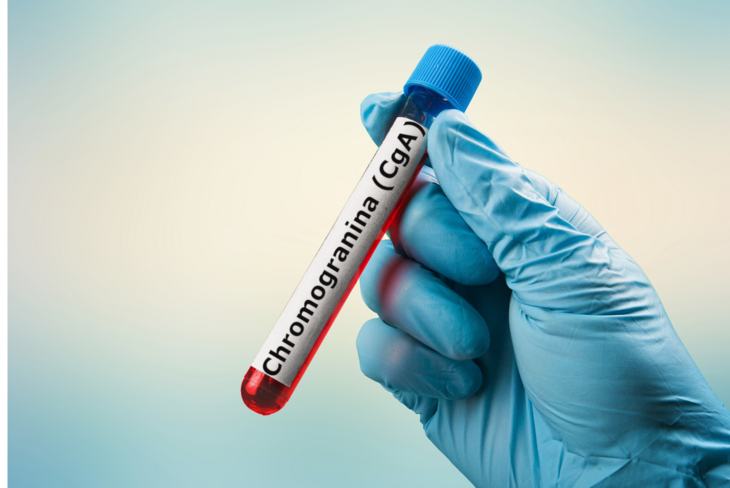 Chromogranina (CgA) należy do tzw. markerów nowotworowych, gdyż jej syntezę pobudzają komórki guzów neuroendokrynnych w przewodzie pokarmowym. / Fot. Adobe Stock