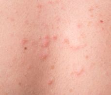 Trądzik grzybiczy – jak wygląda? Czy na trądzik grzybiczy stosuje się maść?