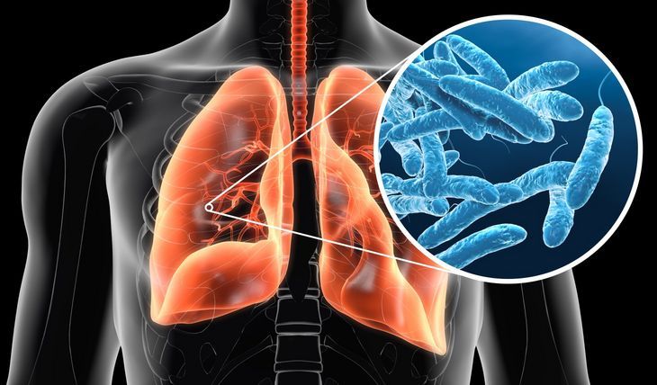 Bakterie Legionella wywołują legionelozę. Jedną z postaci tej choroby jest bardzo niebezpieczna infekcja płuc, zwana chorobą legionistów.
