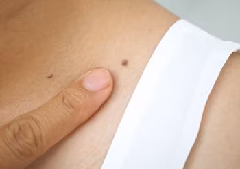 samobadanie znamion i pieprzyków